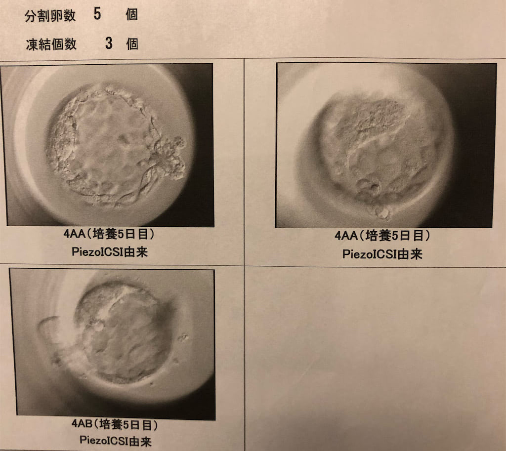 夫婦逆転！？妊活熱高いアラフィフ夫 ＶＳ「こっそり飲みに出た」39歳妻　不妊検査と体外受精の結果を聞いてみた